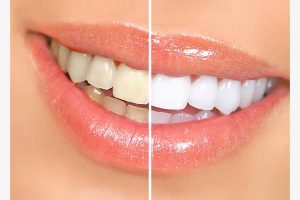 Teeth_Whitening_Strips_7_grande